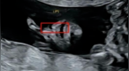 女子称彩超漏诊婴儿唇裂，到卫健委反映问题竟遭怒斥，涉事医院：彩超未看出任何问题